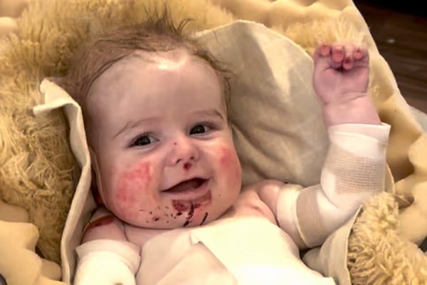 Understanding Epidermolysis Bullosa: A Rare Skin Condition and the Fight for Awareness